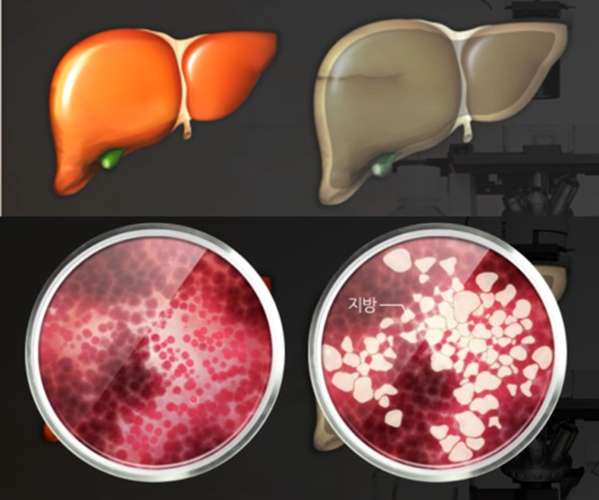정상간 vs 지방간