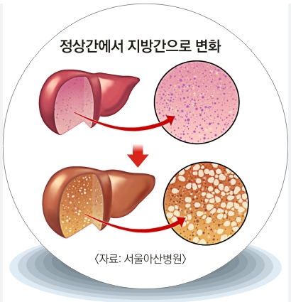 지방간 초기 증상