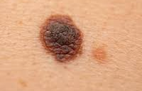 피부암, 조기 발견과 치료 전략