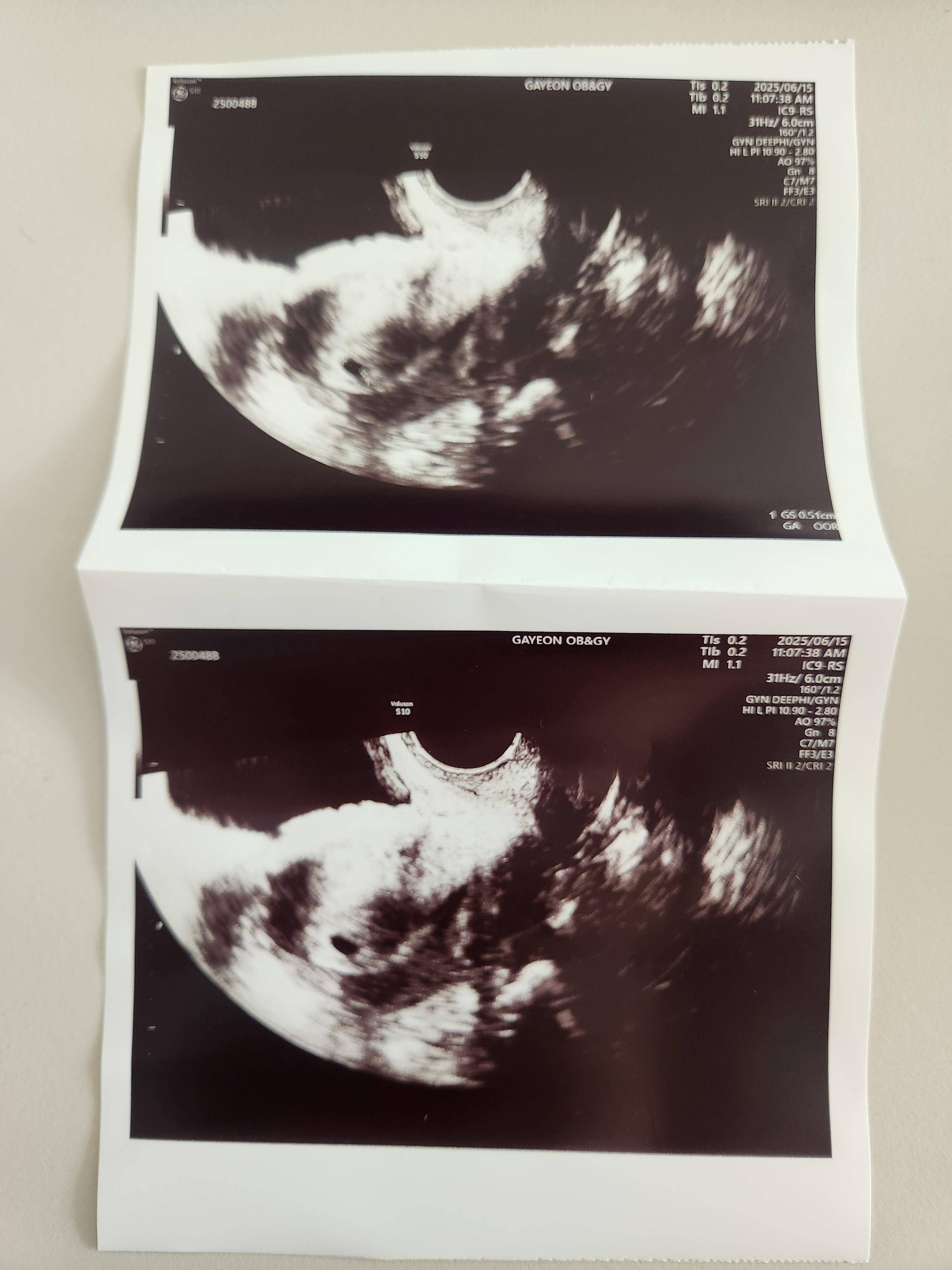 아기집 초음파, 임신5주차 초음파