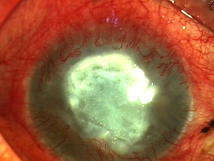 눈 충혈-결막밑출혈-설명하는-사진