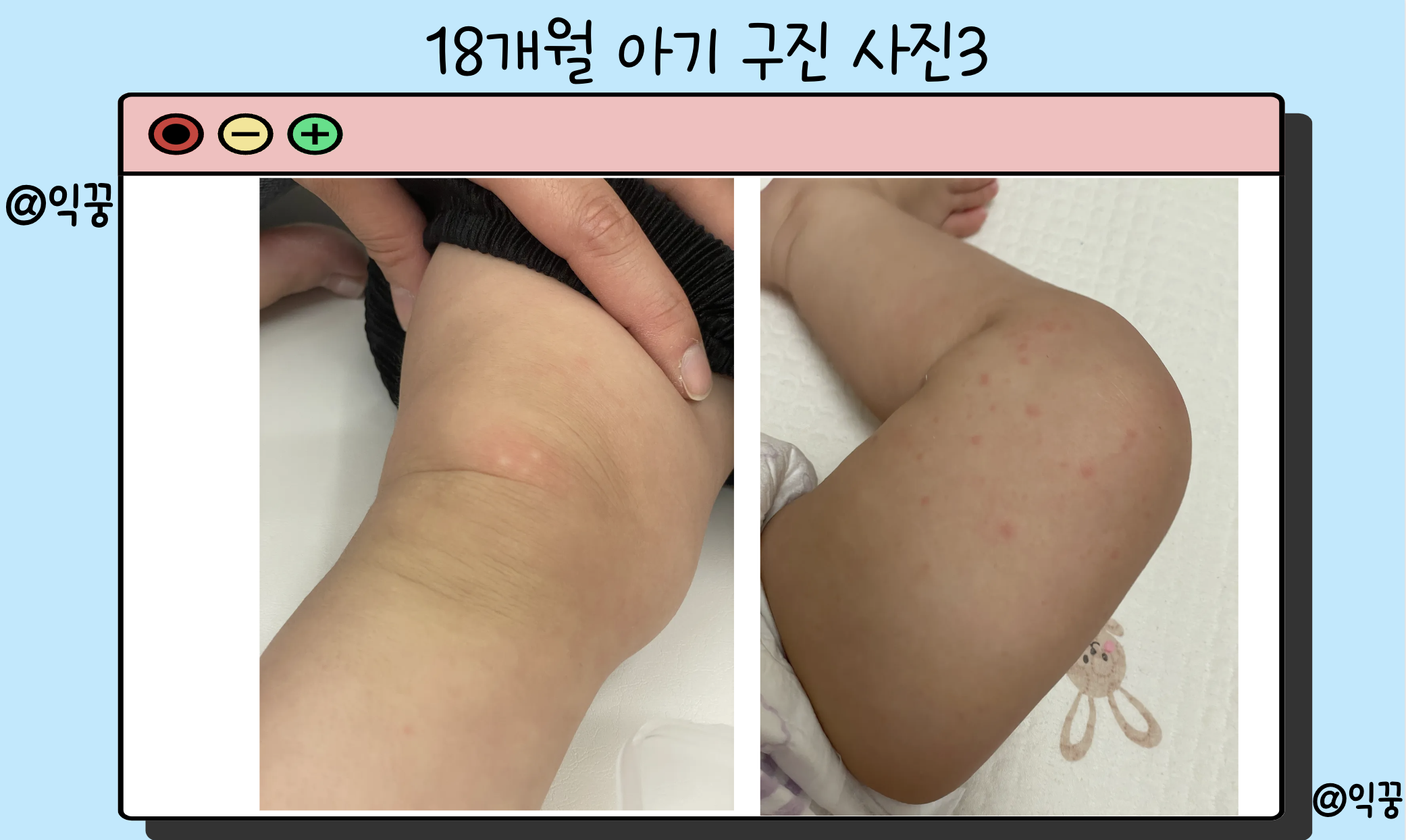 구진 뜻 발생 원인 치료 및 예방법3