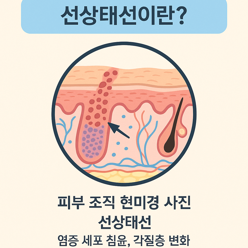 선상태선이란? 딸아이 피부에 나타난 붉은 선의 정체