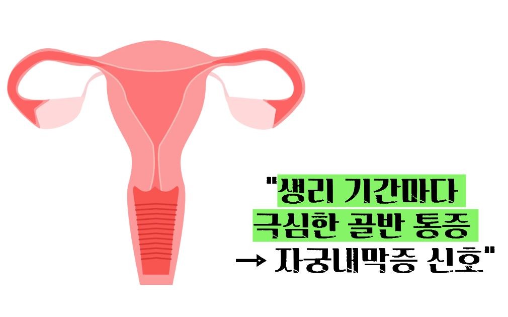 자궁내막증 초기증상