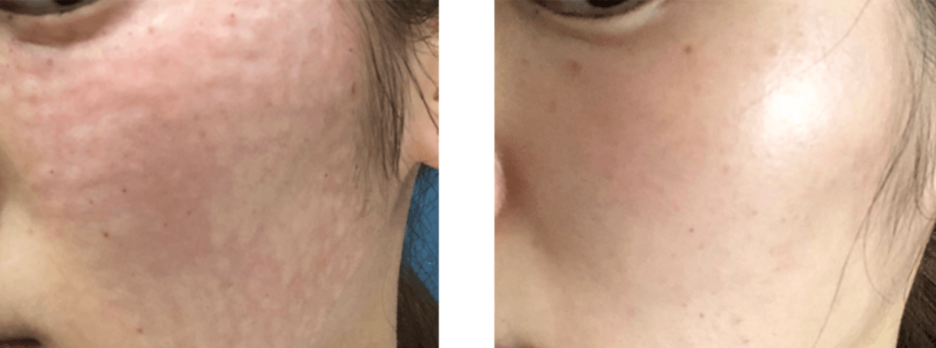 스킨 보톡스 효과 언제부터