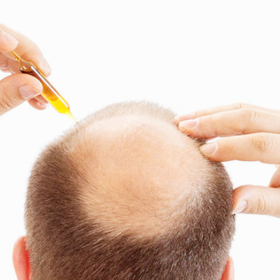 탈모 관련주 대장주 테마주 수혜주 TOP5