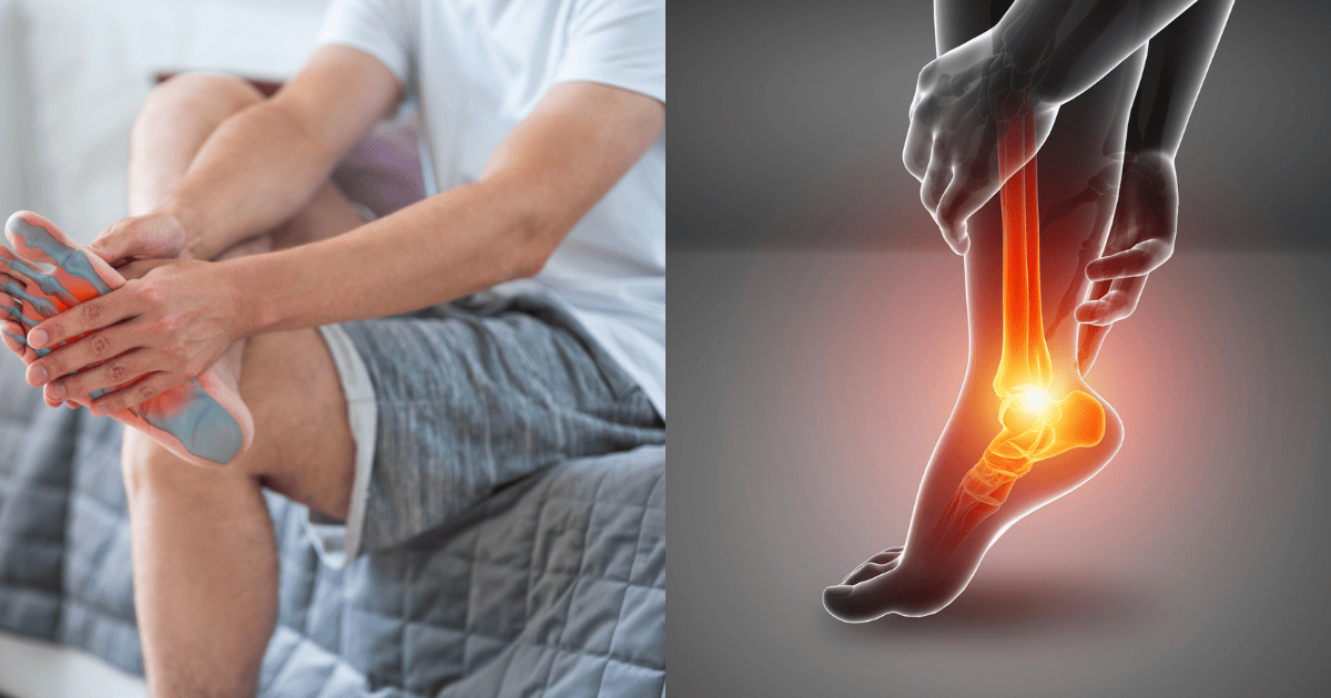 족저근막염으로 발을 붙들고 있는 남성의 하반신과 족저근막염 위치가 나온 엑스레이