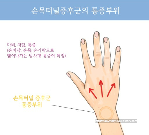 손목터널증후군 - 현대인의 손목이 보내는 위험신호