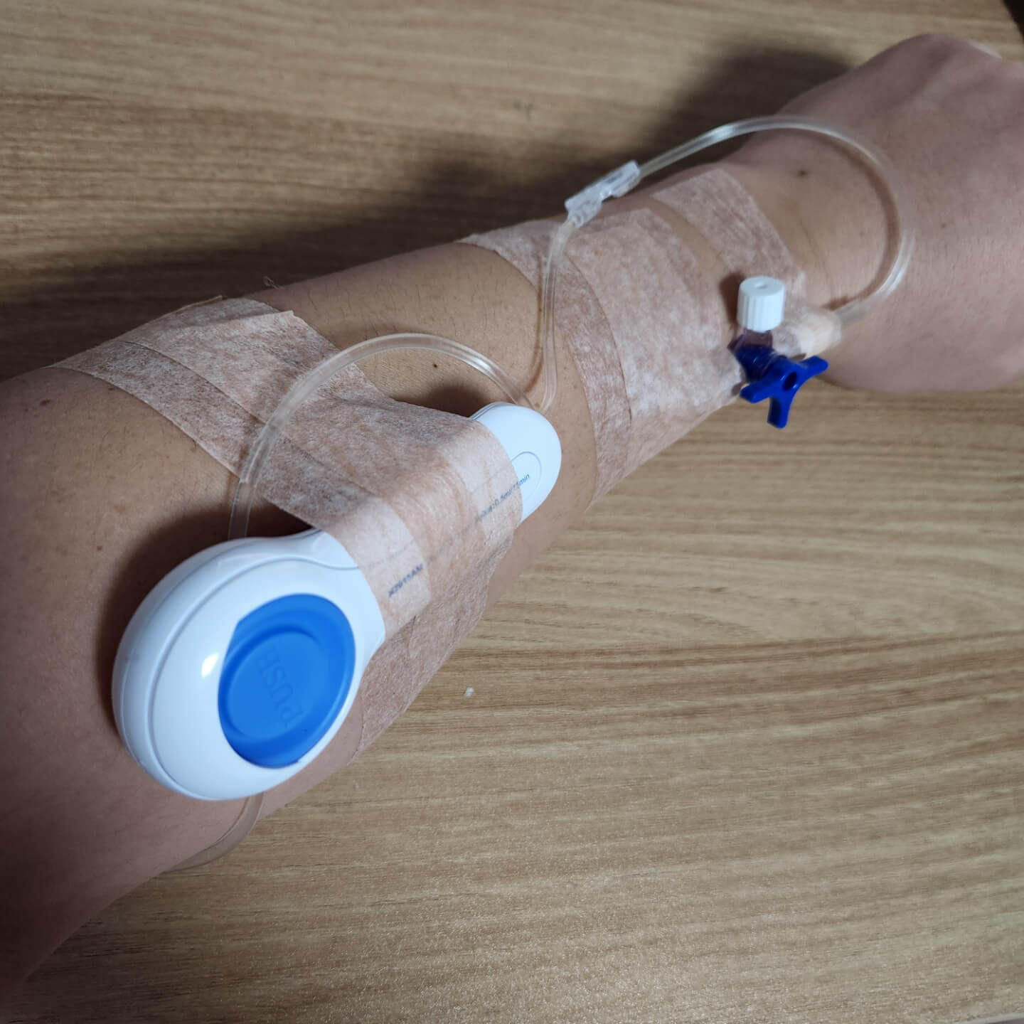 무통주사 퇴원 사진