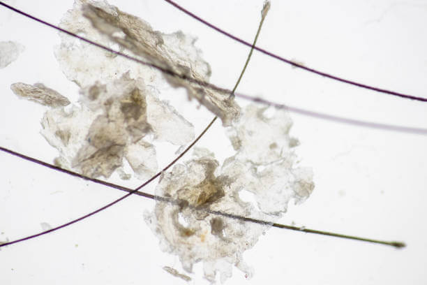 말라세지아의 증식 메커니즘과 지루성 두피염