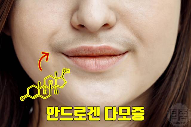 다낭성난소증후군 증상 자가진단 다모증 여드름 m자탈모 여자 살찌는병