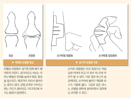 손가락 관절염 증상