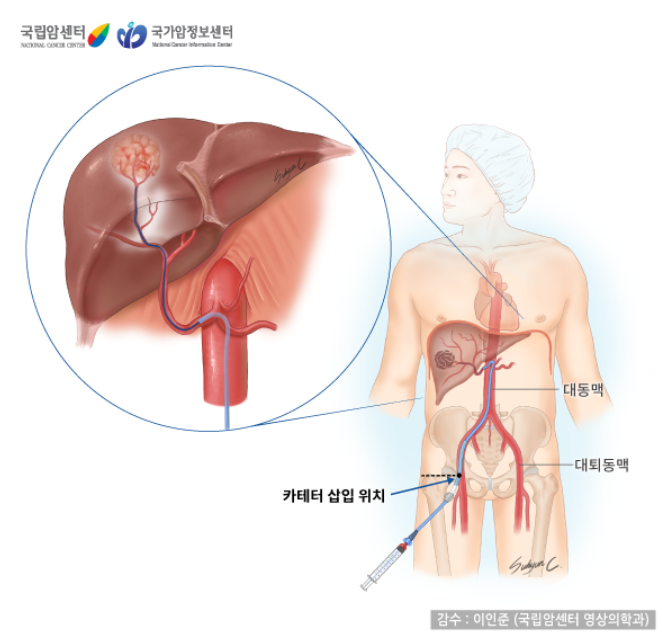 경동맥색전술(Transarterial chemoembolization, TACE)