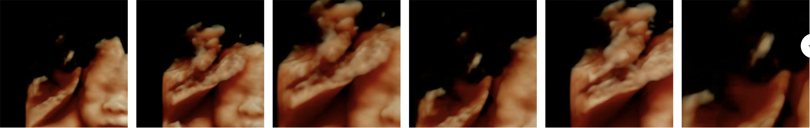 사용자가 수동으로 선택한 입체 초음파 (7번 시도)