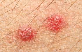 빈대 물린자국 : 빈대 퇴치법, 증상, 예방법