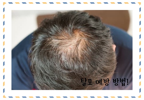 탈모 예방 방법 알아보고 예방