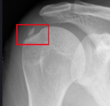 석회성 건염 치료