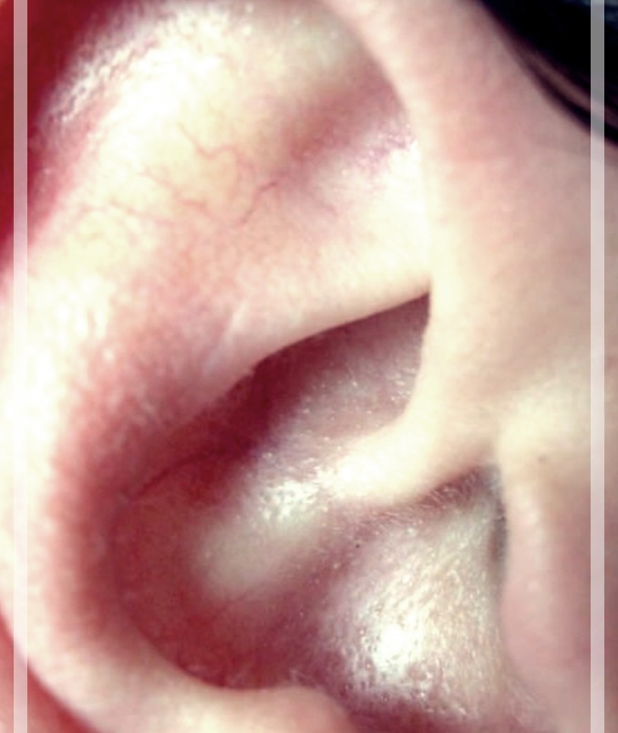 귀고름 방치하면 귀머거리 된는 이유?