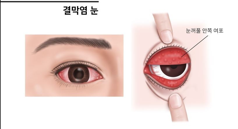 결막염의 일반적인 증상과 특징을 시각적으로 표현한 그림.