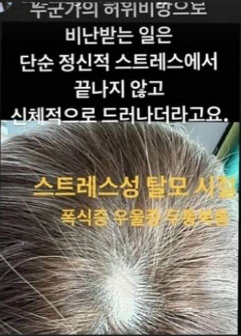 김다예 탈모 우울증