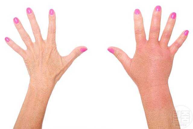 장독소 증상 장독소 빼는법 붓기