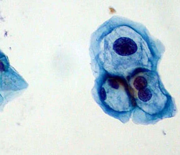hpv 바이러스 증상