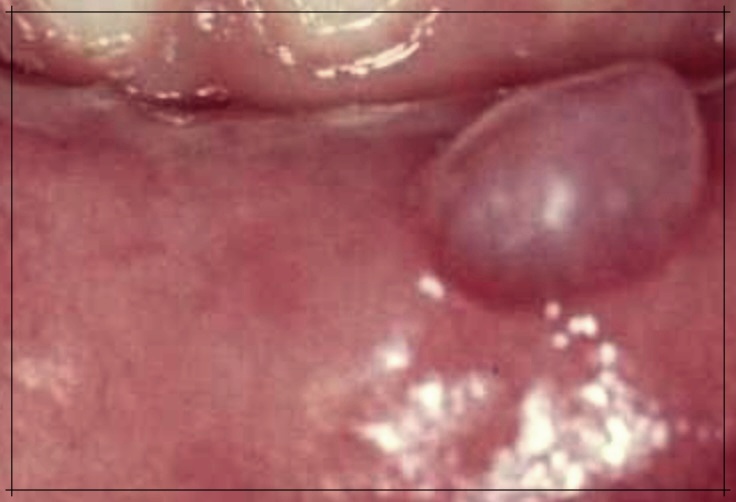 입안 점액낭종 치료 방법, 알고 계신가요?