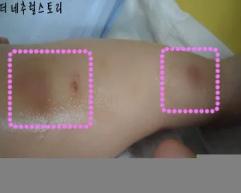 멍든데 바르는 약 연고 BEST 3_23