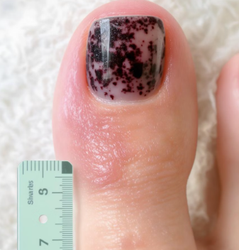 발톱이 검게 변하는 이유 7가지와 해결 방법 3