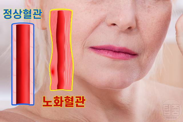 얼굴주름 골다공증 팔자주름 귓볼주름 심장마비