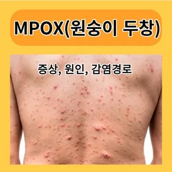 엠폭스 증상 예방접종 대처법 치료방법_6