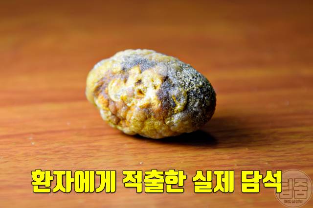 담석증 증상 초기증상 기름진음식