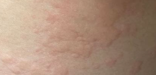 두드러기 원인2