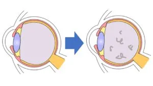 비문증-원인-날파리증- 광시증-왜-생기는-걸까?-비문증-자연치유-부터-치료-방법까지-확인하기