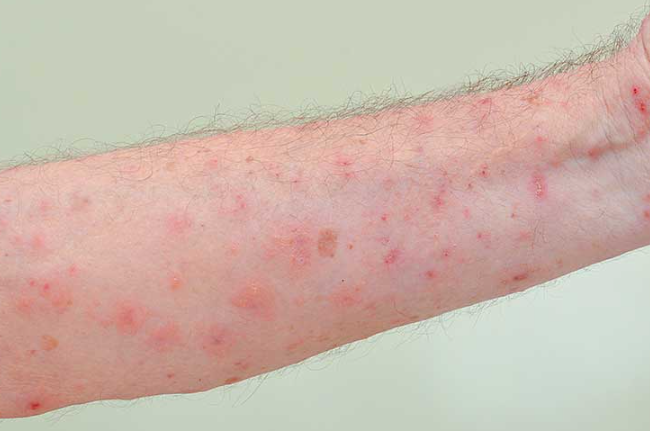 근육통이 보내는 질병 신호