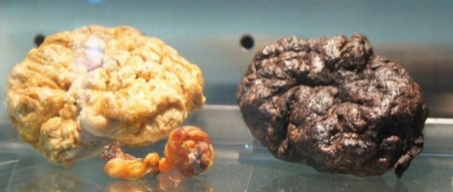 산모가 출산을 하고 나서 배출되는 태아부속물 중의 하나인 태반을 찍은 사진으로 왼쪽에는 노란색 태반과 오른쪽에는 검은색 태반을 나란히 놓아두고 찍은 사진