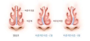 비중격 만곡증