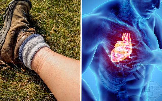 다리 양말자국 질환 코끼리다리 무다리 원인 심부전