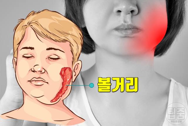 귀밑 턱 부음 원인 볼거리 귀밑 턱이 부었어요