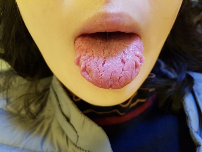 쇼그렌증후군