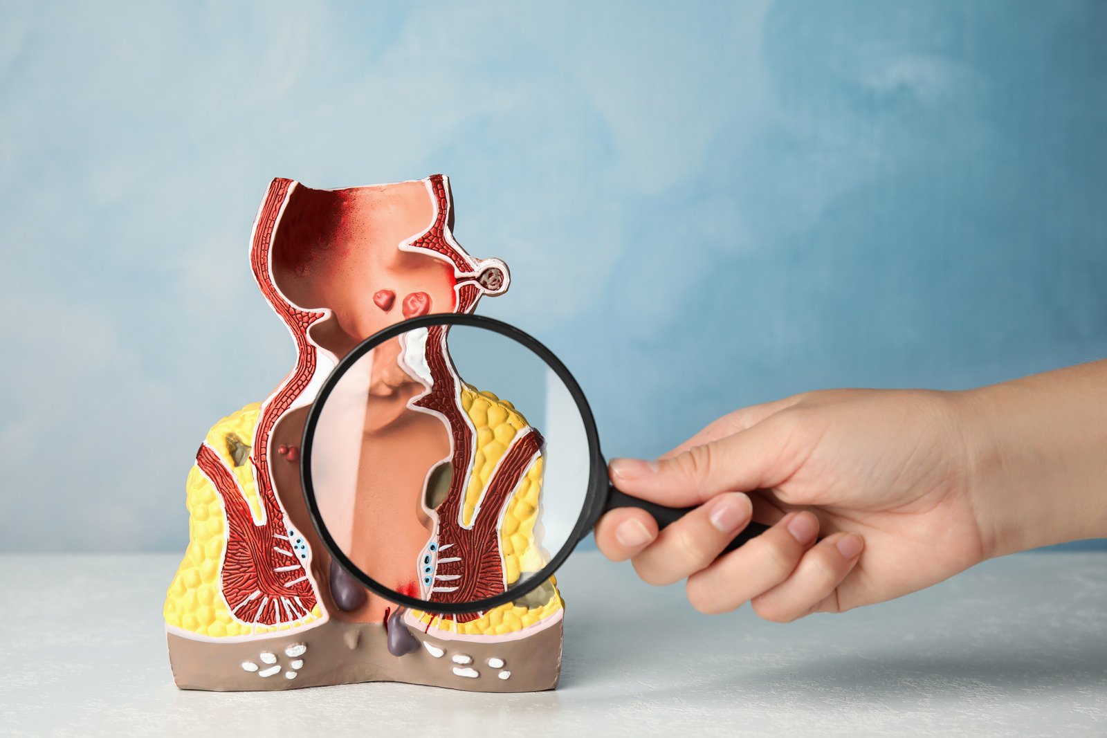치루(Fistula-in-ano): 원인, 증상, 진단, 치료 및 예방
