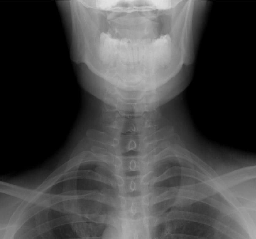목디스크 정확한 진단 방법과 검사법 X-ray 검사
