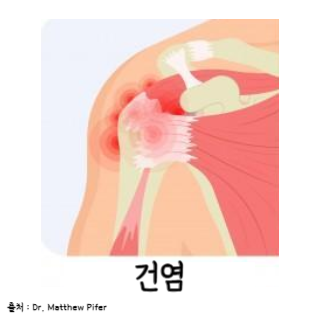 어깨통증원인