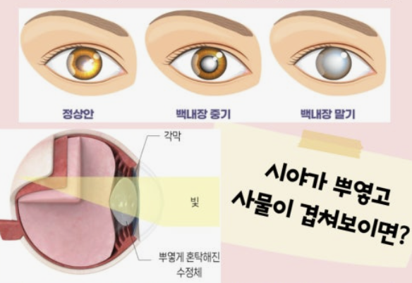 백내장 원인과 치료방법