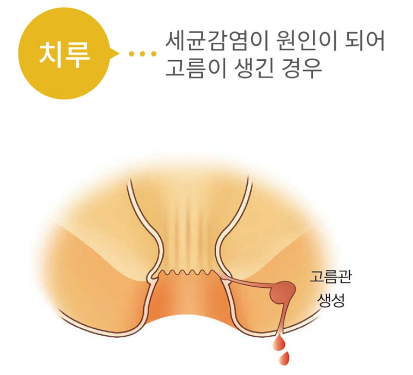 치루
