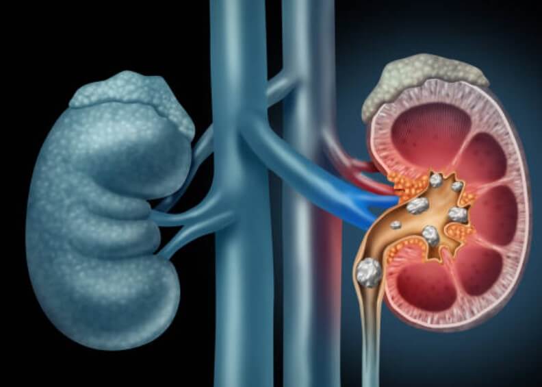 신장에나쁜음식
