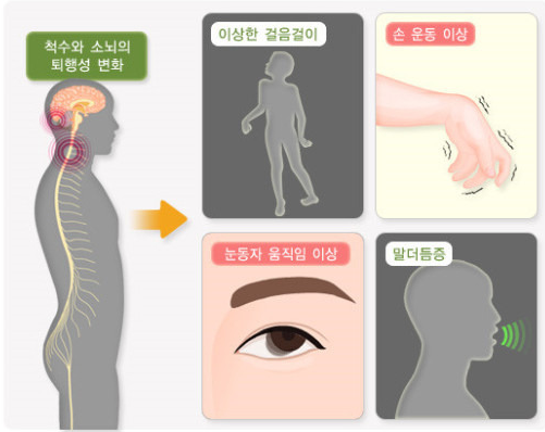 소뇌위축증