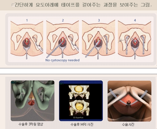 요실금 수술 설명 이미지