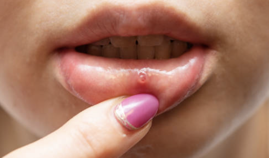 입술에 물집이 생기는 이유 34