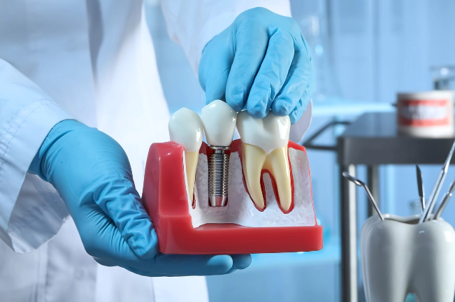 임플란트